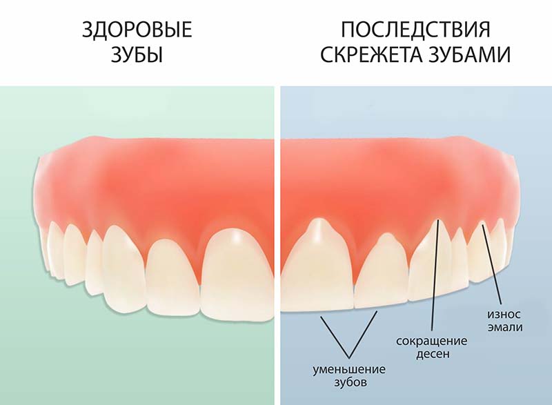 Как лечить чувствительность зубов?